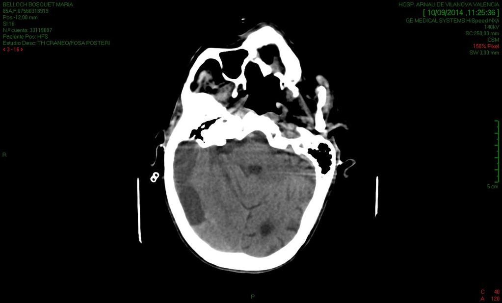 Lectura del TAC Higroma subdural hemisférico derecho con cámara de 24 mm y signos de sangrado reciente.