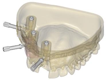 El objetivo es poder posicionar el análogo de forma correcta en el modelo, simulando la posición exacta del implante en boca, ya sea en la dimensión vertical como en el posicionamiento real de la