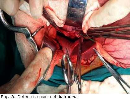 3), con hernia en el estómago, bazo y colon hacia el tórax.