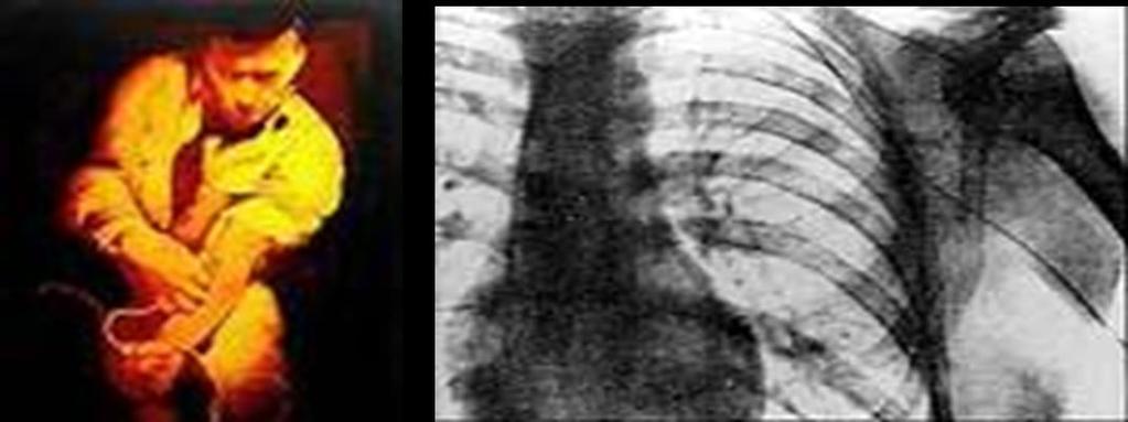 O O O O 1929-Forssmann cateteriza una vena de su brazo y documenta la presencia de un catéter en la AD radiológicamente 1937- A.
