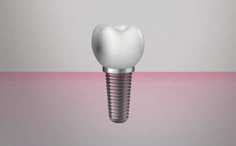 El espectro de tratamientos CEREC se ha ampliado a tres áreas clave: restauraciones, implantes y ortodoncia, de modo que dispone de un equipo completo para el futuro.
