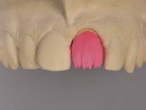 ESTRATIFICACIÓN DE LA DENTINA Y EL ESMALTE 1 2 La morfología labial y oclusal se construye primero con material de dentina del color