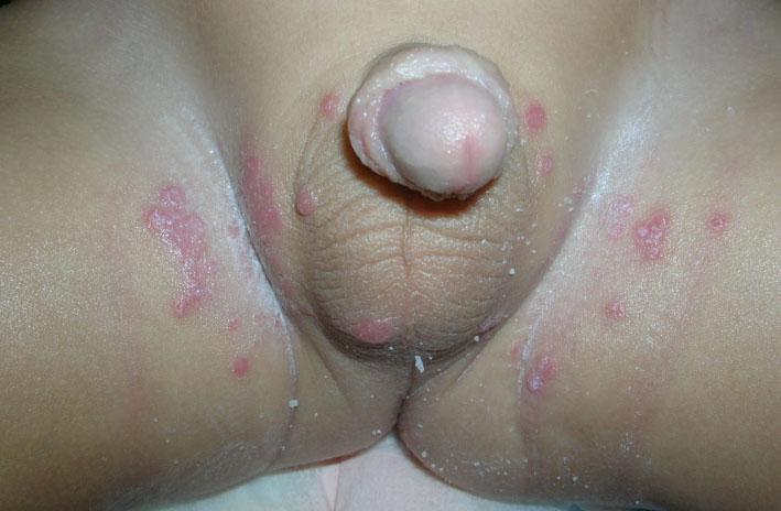 Caso Clínico 2 Dermatitis por pañal sifiloide