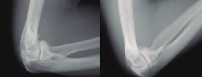 Tratamiento artroscópico de la rigidez del codo: artrofibrosis Introducción Rigidez y función del codo La función del codo es situar, orientar y estabilizar la mano en el espacio cerca o lejos del
