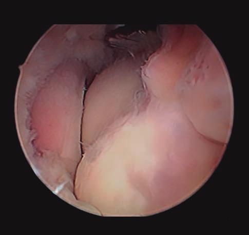 Tratamiento artroscópico de la rigidez del codo: artrofibrosis copio y del instrumental de trabajo, y el anterolateral proximal para el uso de un separador.