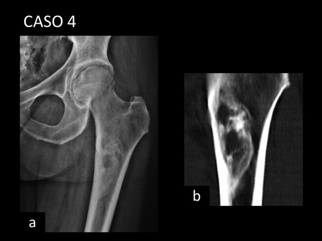 Fig. 5: Paciente con dolor de cadera y muslo izquierdo de meses de evolución, con limitación de la movilidad.