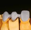 ceramotion PMe Configuración de las estructuras La estructura reproduce un diente de forma anatómicamente reducida; hay que evitar las esquinas y cantos en la estructura.