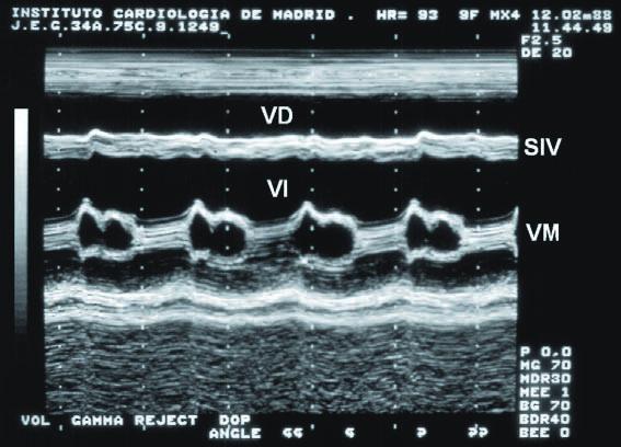 Manual de Ecocardiografía cular izquierda, con grosores conservados y con una disfunción ventricular muy importante, con fracción de eyección disminuida en diversos grados de severidad.