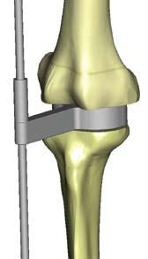 mas espesa del semi-espaciador 8 Determinación de la talla antero-posterior del implante femoral Cuando