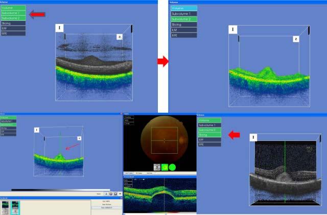 los DEPs con más precisión, se ha desarrollado la siguiente técnica: Se entra en 3D imageviewing : Se elimina el volumen de las capas internas de la retina, se coloca un eje-marcador en el punto más