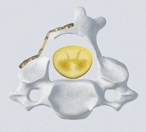 Presentación El sistema de laminoplastia ARCH está indicado para: Mantener expandido el canal espinal Asegurar la estabilidad de la columna vertebral Conservar la capa protectora de