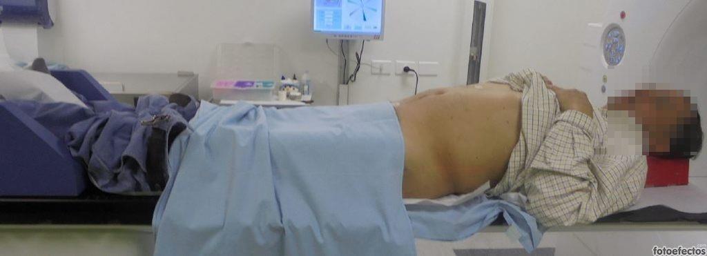 Simulación RT abdomen y pelvis Próstata, Ca Cu, Vejiga, Seminoma.
