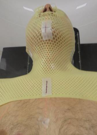 Simulación RT cabeza y cuello Lesiones en