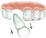Subluxación: Movilidad anormal sin desplazamiento del diente. Subluxación intrusiva o dislocación central: Desplazamiento del diente en el hueso alveolar que se encuentra fracturado.