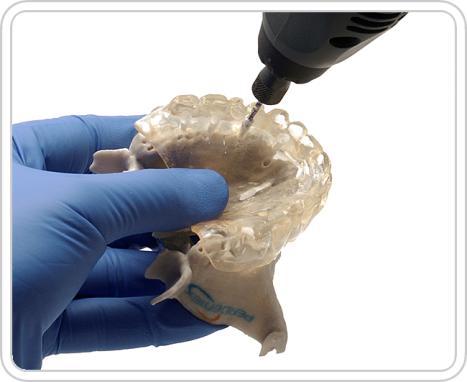 Al contar con una réplica de prótesis debidamente referenciada con respecto al maxilar es posible planificar la colocación de