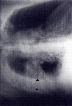 Figura 1. Radiografía en decúbito lateral sobre el lado afectado con rayo horizontal : el líquido se desplaza y se acumula sobre la pared costal formando una capa cuyo espesor puede medirse.