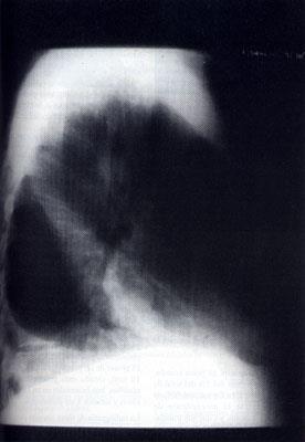 Figura 3. En proyección lateral el derrame acumulado en la cisura mayor da una imagen triangular oblicua.