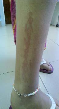 Figura 2. Hiperpigmentación residual, tras tatuaje de henna, localizada en el dorso de la pierna derecha.