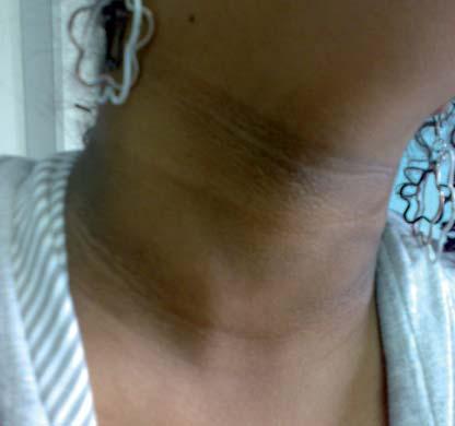 Figura 3. Acantosis nigricans en una joven de 13 años. mentación residual marcada en algunos casos, y con consecuencias en ocasiones poco estéticas para el paciente 3.