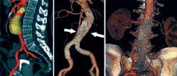 316 Uribe y cols. Evaluación inicial Siempre se debe evaluar con dos métodos por imagen: tomografía axial computarizada y angiografía con pig tail milimetrada.