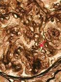 Solo queda imagen de lobulación del ovillo en dos glomérulos inmersos en una zona de inflamación intersticial.
