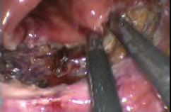 En defectos pequeños se inicia en un extremo y con una sutura continua se finaliza en el otro