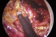 Posteriormente con el bisturí ultrasónico se inicia la exéresis siguiendo la misma estrategia que con cualquier lesión, se inicia por el borde más distal de la tumoración en sentido céfalo-caudal del