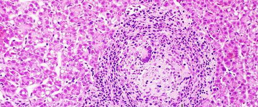 DEFINICIÓN MORFOLÓGICA DE GRANULOMA Un granuloma es un agregado de histiocitos, asociado a menudo con otras células inflamatorias, claramente delimitado del parénquima vecino, que se desarrolla en