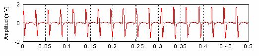 4 T i e m p o ( s e g ) Detección Detección señales señales Artefacto l estímulo Onda M