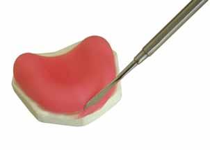 La cuchilla en forma de hoz del instrumento permite una fácil omisión de las bandas y de los dientes restantes.