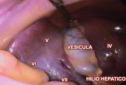 6: Vista anteroinferior de Higado donde podemos observar los subsegmentos V, VI, VII, VIII y tomando como reparo anatómico el borde