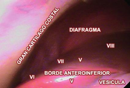3: Vista inferior del hígado mediante videolaparospía visualizando los subsegmentos II, III, IV y como reparo anatómico la vesícula Fig.
