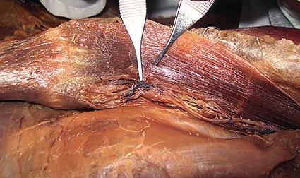 1) Hoja anterior de la vaina del recto, 2) Arteria epigástrica inferior, 3) Músculo recto anterior Fig. 8: Vasos epigástricos superior e inferior.