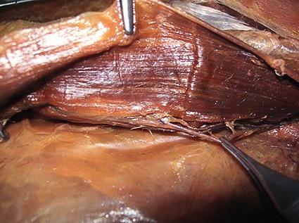 1) Hoja posterior de la vaina del recto anterior, 2) Epiplón mayor y vísceras de la cavidad abdominal Dentro de la vaina del musculo recto del abdomen se encuentra de abajo hacia