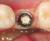 .se estratifican los correspondientes materiales Deep Dentin, Dentin