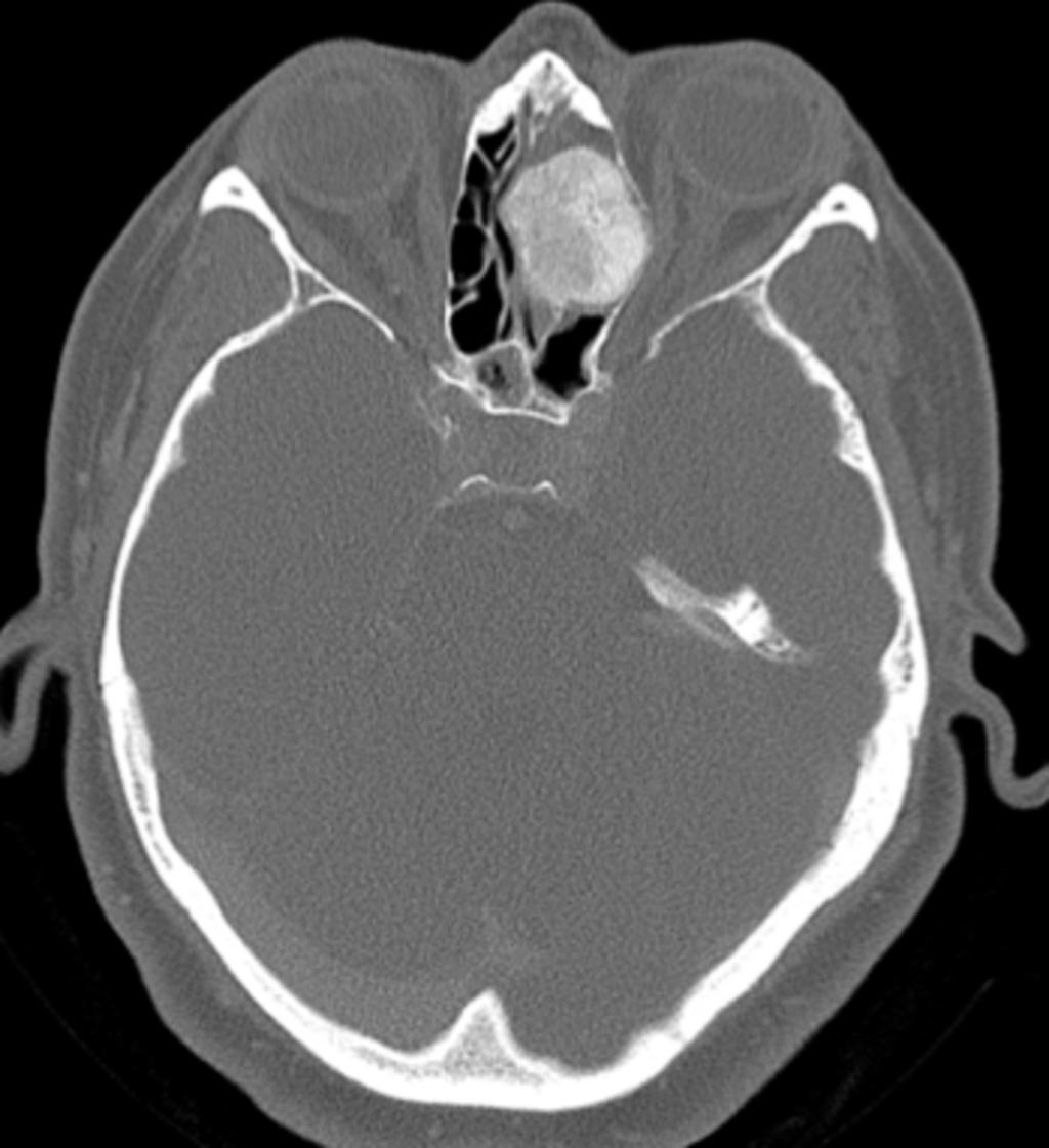 Fig. 9: Caso 2: mujer de 47 años con glomus carotídeo derecho, post-embolización Fig. 10: Hemangioma intaóseo nasal.