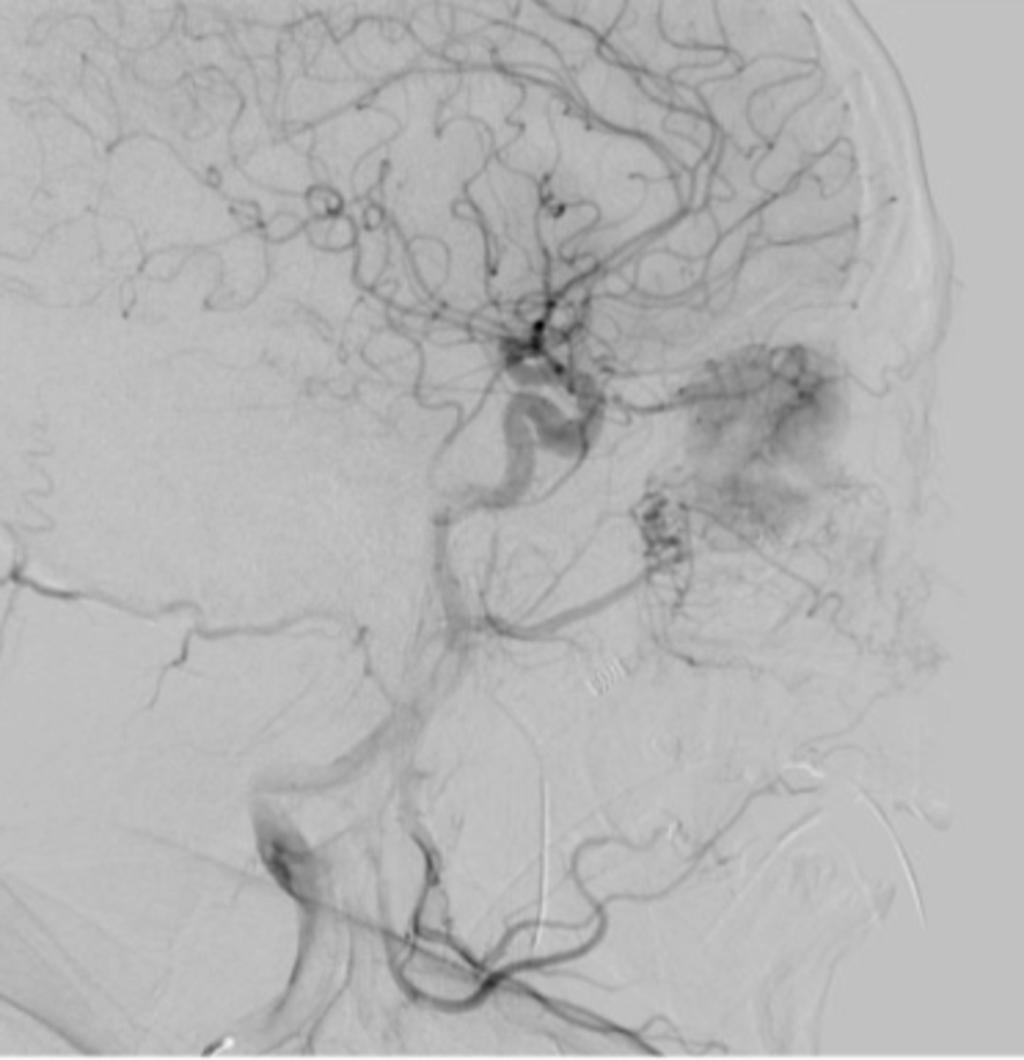 Fig. 11: Arteriografía desde carótida común izquierda.