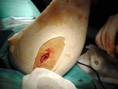 Fig. 1B: Segunda incisión en cara posterolateral del antebrazo. Fig.