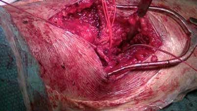 En 3 pacientes se empleó una fijación transósea del tendón a través de la tuberosidad bicipital utilizando hilos de sutura (21 4%). En 10 casos (71 4%) se utilizaron arpones de sutura.