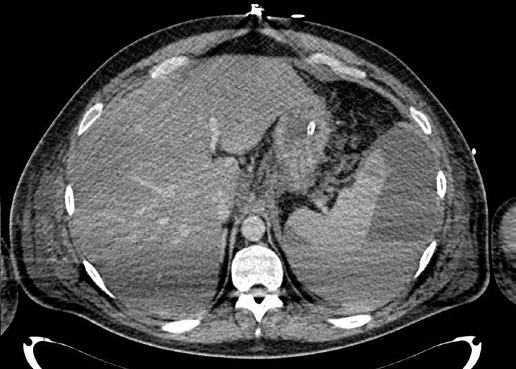 Figura 2: TC abdominal con contraste endovenoso.
