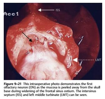 TÉCNICA QUIRÚRGICA Resección tabique interseno frontal + piso de ambos senos