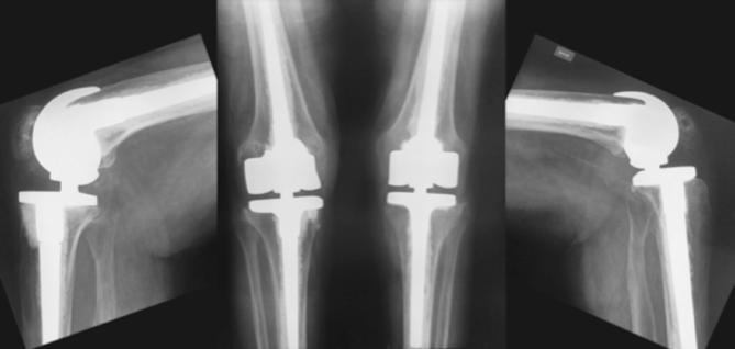 grave defecto óseo en el platillo interno y genu valgo
