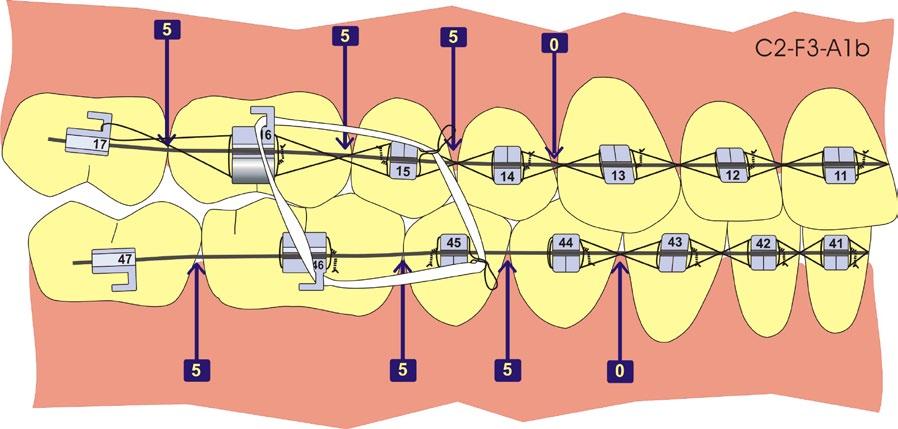 025 b-titanio - Compensación oclusal 5-5-5-0 - Ligadura continua de 44 a 34 - Contracción molar
