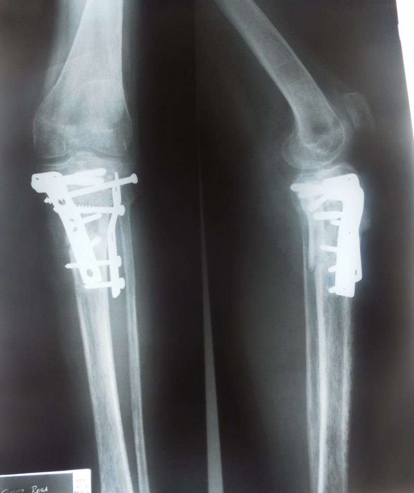 Antecedentes Con diagnóstico de fractura expuesta de rodilla izquierda (fractura de ambos platillos tibiales y fractura de cabeza de peroné )se le realizó osteosíntesis con 2 placas en L internas y