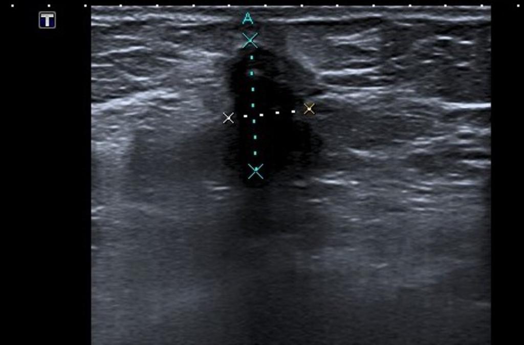 Fig. 11: Proyección craneocaudal de mama derecha realizada a la paciente de la figura 10, visualizando nódulo de contornos mal delimitados en cuadrantes internos. Fig.