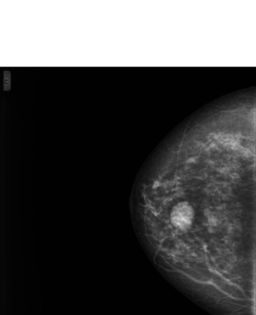 Fig. 2: Mamografía en proyección craneocaudal de mama derecha donde