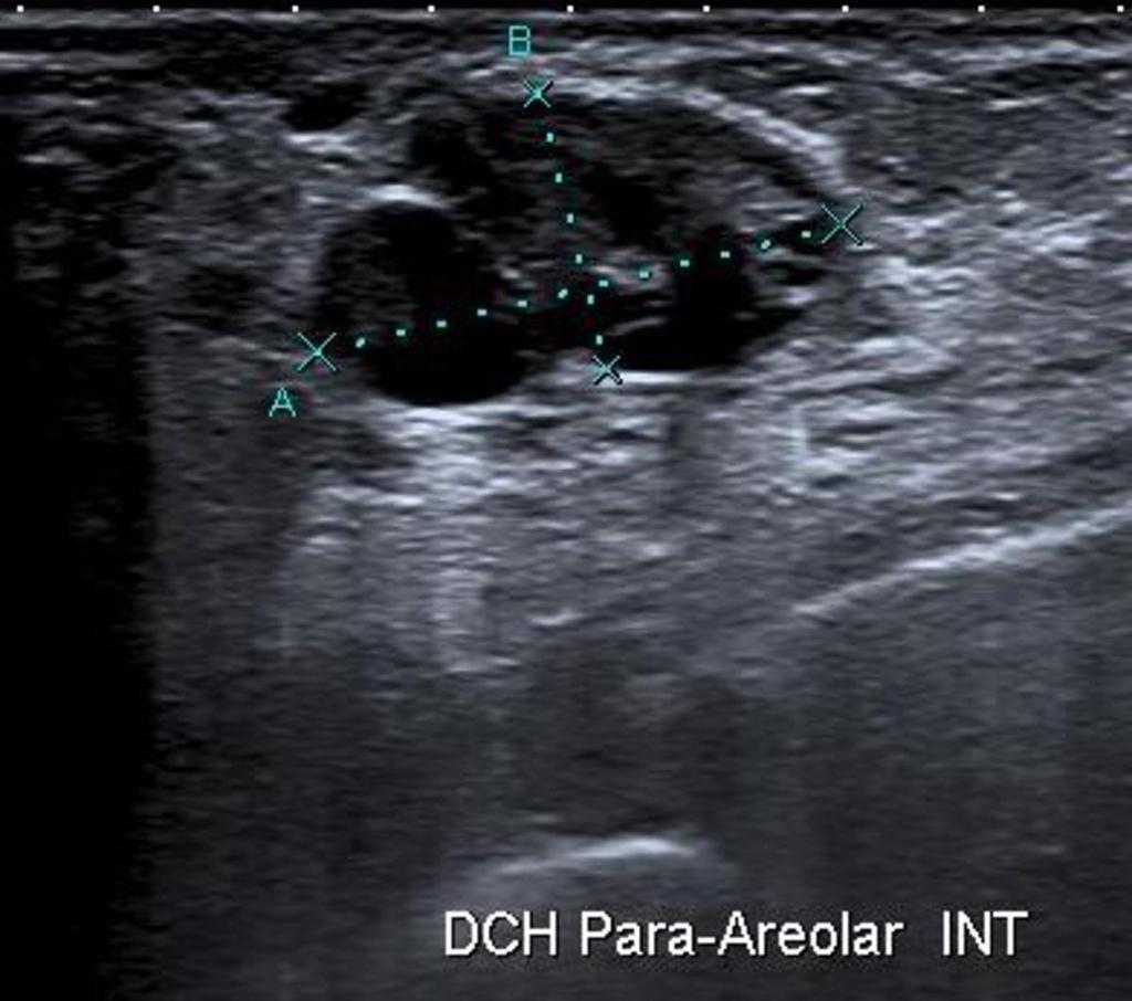 Fig. 5: Proyección mamográfica oblicuamediolateral (OML) de mama derecha, identificando un nódulo lobulado bien definido infraareolar. Fig.