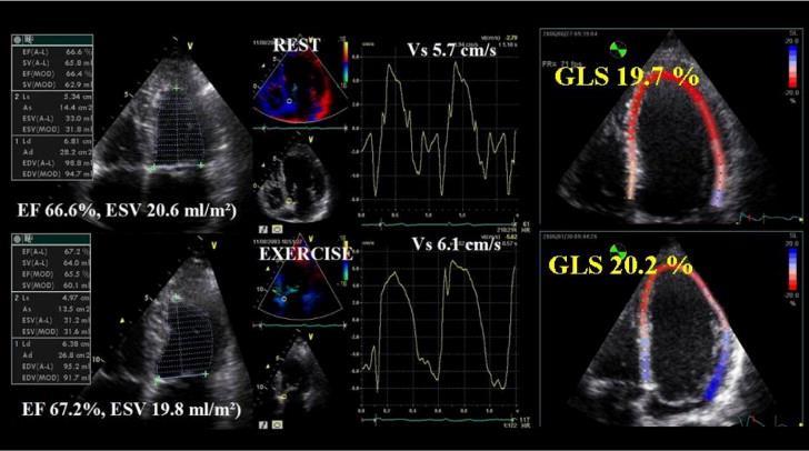 Importance of Left Ventricular Longitudinal Function and Functional Reserve in Patients With Degenerative Mitral Regurgitation: Assessment by Two-Dimensional Speckle Tracking Reposo Ejercicio