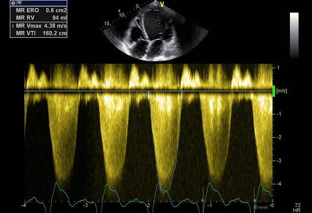 Ecocardiografía de la Válvula Mitral Información exacta y precisa : Tipo y extensión de las lesiones anátomicas