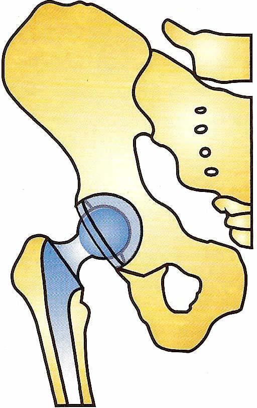 Cuando se trata de una prótesis total, se implanta además una cúpula de plástico, de metal o de cerámica en la cavidad esférica de la pelvis (cotilo) que está dañada.